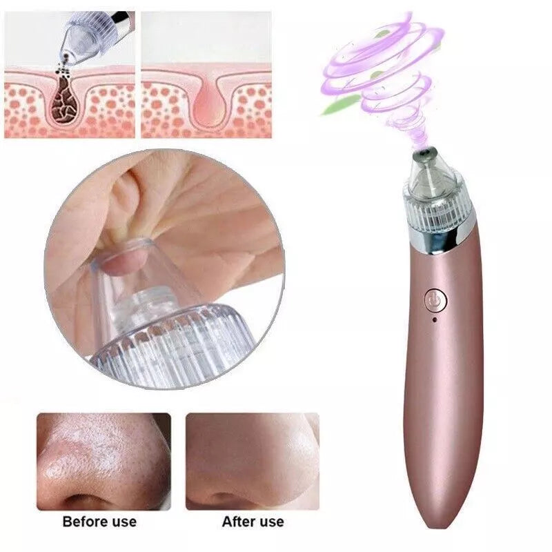 Blackhead Remover Vacuum Acne Cleaner – Deep Pore Cleansing for Flawless Skin